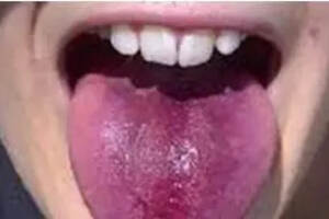 解读喝葡萄酒后舌头发黑现象，如何解决舌头牙齿发黑