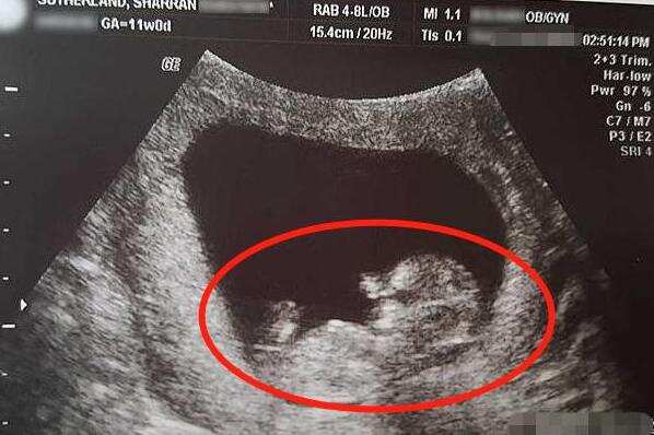 孕妈14周流产，胎儿“照片”曝光让人痛惜：仅10厘米手脚都已成型