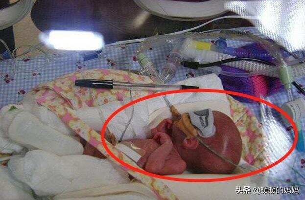 还记得世界最小婴儿吗？出生仅280克，14年后的她“美”得不像话