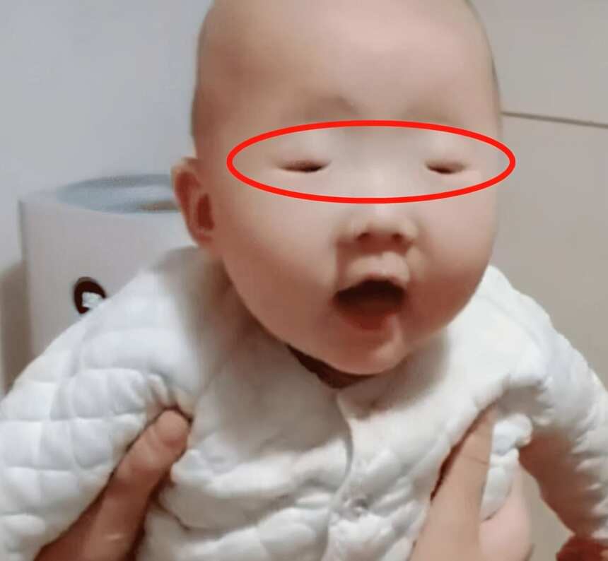 宝宝出生“豆豆眼”急坏妈妈，送医检查后医生却笑了：是你想多了