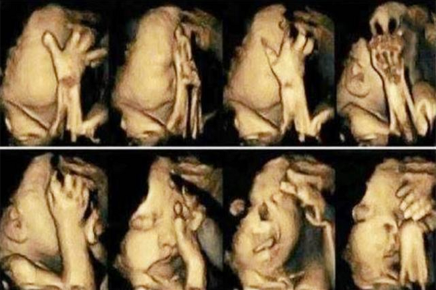 孕检发现胎儿“做鬼脸”，孕妈喜不自胜，医生却叹气：这娃不能要