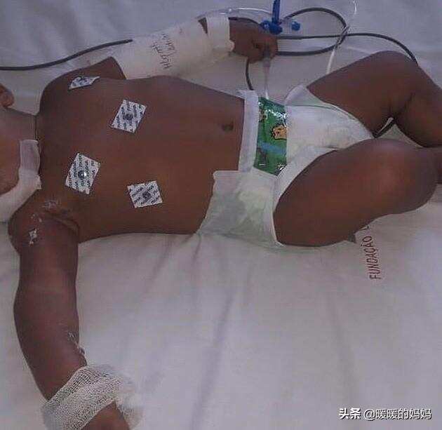 6个月宝宝将“电线”咬漏电，被电晕后又烧伤，父母发现后哭惨了