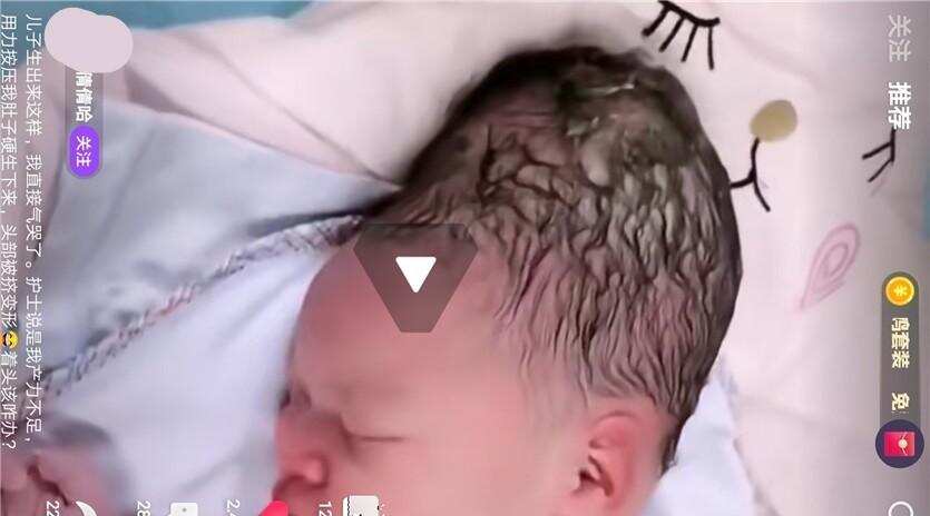 分娩时产力不足，宝宝脑袋被挤成“古装发鬓头”，宝妈直接被气哭